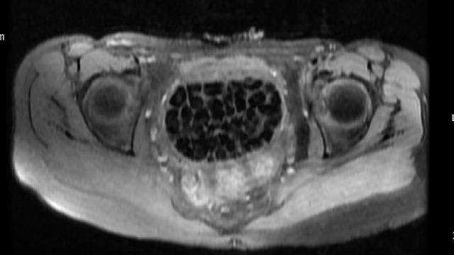 Hepsi vücudundan maden gibi çıkartıldı: Tam 287 tane! 2,5 santim boyutunda... 7