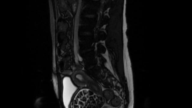 Hepsi vücudundan maden gibi çıkartıldı: Tam 287 tane! 2,5 santim boyutunda... 8