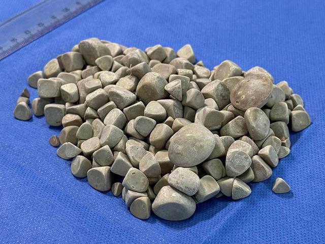 Hepsi vücudundan maden gibi çıkartıldı: Tam 287 tane! 2,5 santim boyutunda...