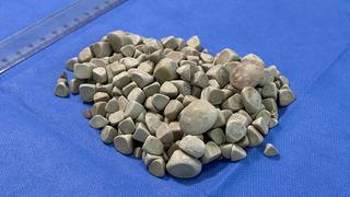 Hepsi vücudundan maden gibi çıkartıldı: Tam 287 tane! 2,5 santim boyutunda...