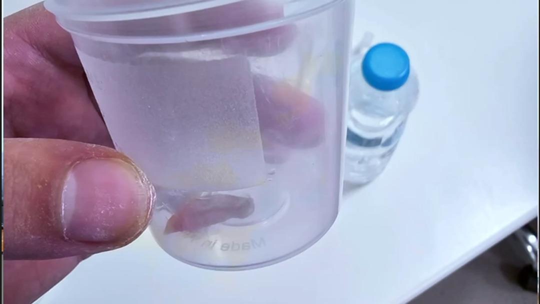 1,5 yıllık öksürüğün nedeni şaşırttı: Akciğerinden kabak çekirdeği çıktı! 2