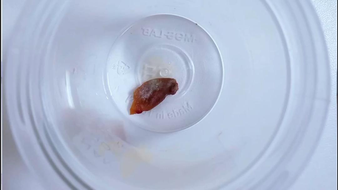 1,5 yıllık öksürüğün nedeni şaşırttı: Akciğerinden kabak çekirdeği çıktı! 1