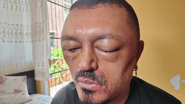 İnternetten aldığı şampuan kafasını ve yüzünü şişirmiş! Uzman isimden bilinçsiz cilt ürünü kullanımına karşı uyarılar...