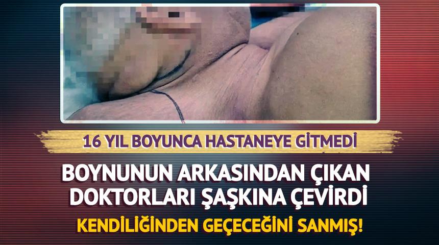 Boynunun arkasından çıkan doktorları şoka soktu