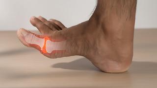 Gut hastalığı nedir? Gut hastalığında beslenme nasıl olmalıdır? Gut hastalığı diyet planı ve pürin diyeti