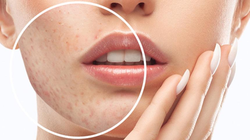 Akne tedavisinde en sık karşılaşılan cilt problemi: "Silgiyle silinmiş gibi yapan bir tedavi yöntemi yoktur"