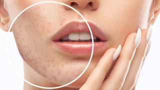 Akne tedavisinde en sık karşılaşılan cilt problemi: Silgiyle silinmiş gibi yapan bir tedavi yöntemi yoktur