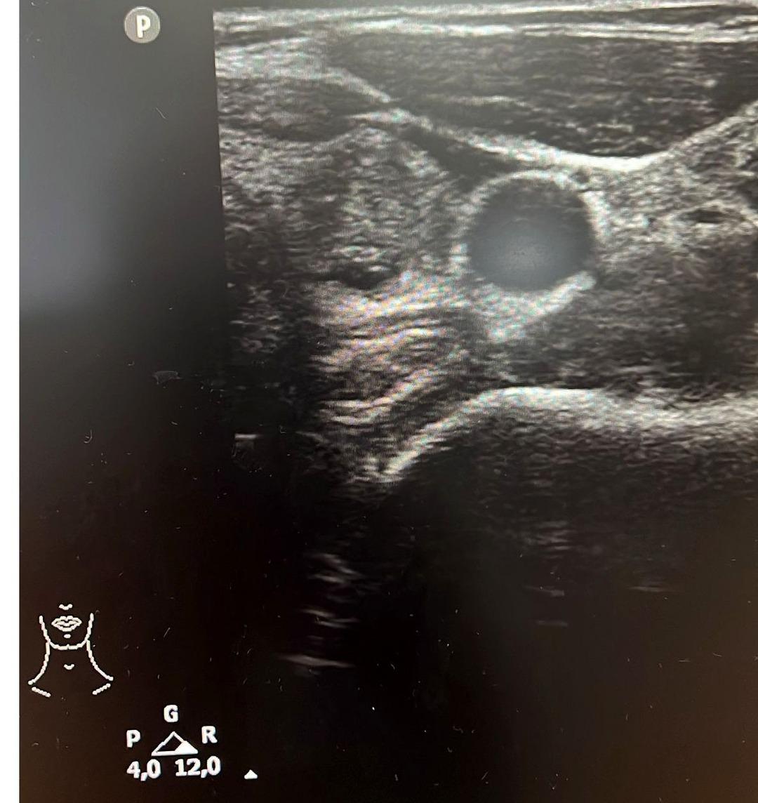 Kadınlarda daha sık görülen bu hastalıkta korkutan durum! Tiroit nodüllerinde artış: "En yaygın nedeni iyot eksikliği" 4