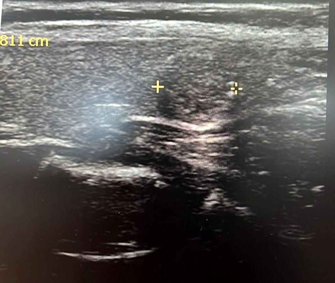 Kadınlarda daha sık görülen bu hastalıkta korkutan durum! Tiroit nodüllerinde artış: "En yaygın nedeni iyot eksikliği" 2