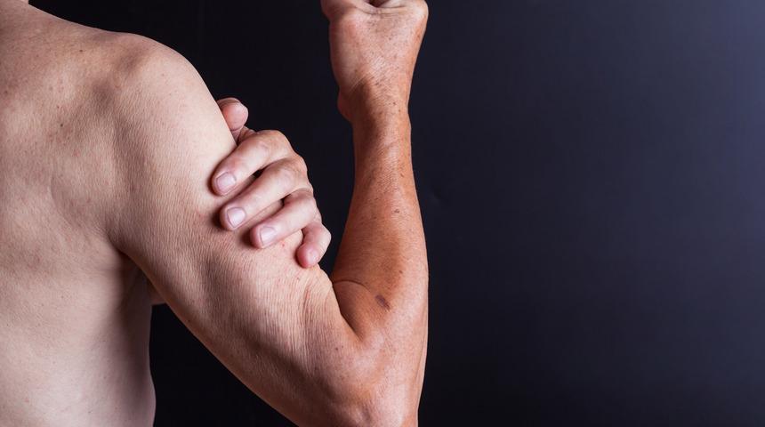 Kas erimesi nedir, neden olur?