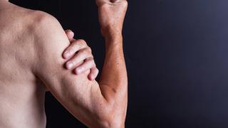 Kas erimesi nedir, neden olur?