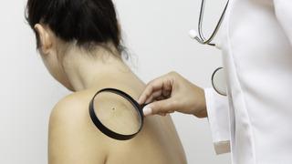 Melanom nedir, diğer cilt kanserlerinden farkı nedir?