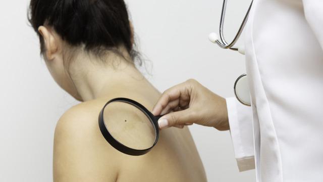 Melanom nedir, diğer cilt kanserlerinden farkı nedir?