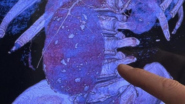 Modern dünyanın sessiz pandemisi: Kalp damar hastalıkları!