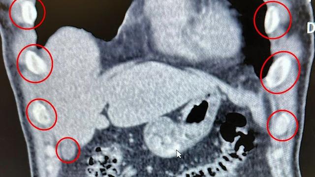 Yer: Bitlis! Midesinden 136 uyuşturucu kapsül çıktı