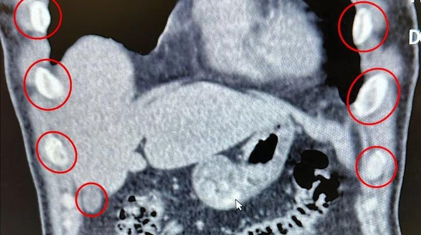 Midelerinden 136 kapsül uyuşturucu çıkan yabancı uyruklu 2 kişi gözaltına alındı