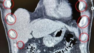 Midelerinden 136 kapsül uyuşturucu çıkan yabancı uyruklu 2 kişi gözaltına alındı