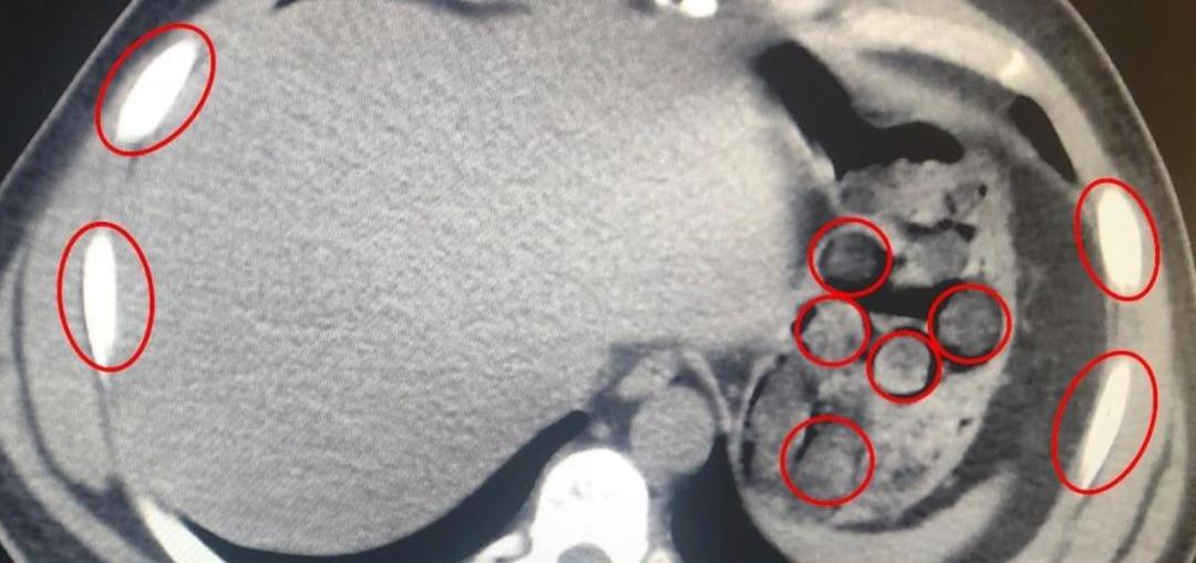 Midelerinden 136 kapsül uyuşturucu çıkan yabancı uyruklu 2 kişi gözaltına alındı 1