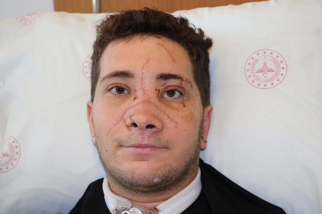 İzmir’de mucize kurtuluş... Yüzde 90 ölüm riski vardı: Kazada burnu kopma noktasına gelen genç hayata tutundu 3