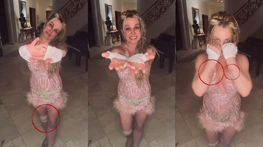 Dünyaca ünlü şarkıcı Britney Spears sevenlerini korkuttu! Dizindeki bandaj ve kolundaki morluklar dikkat çekti
