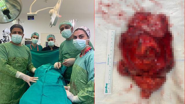 Her şey geçmeyen öksürükle başladı... Tıpta ender rastlanıyor: Dev tümör ameliyatla çıkarıldı!