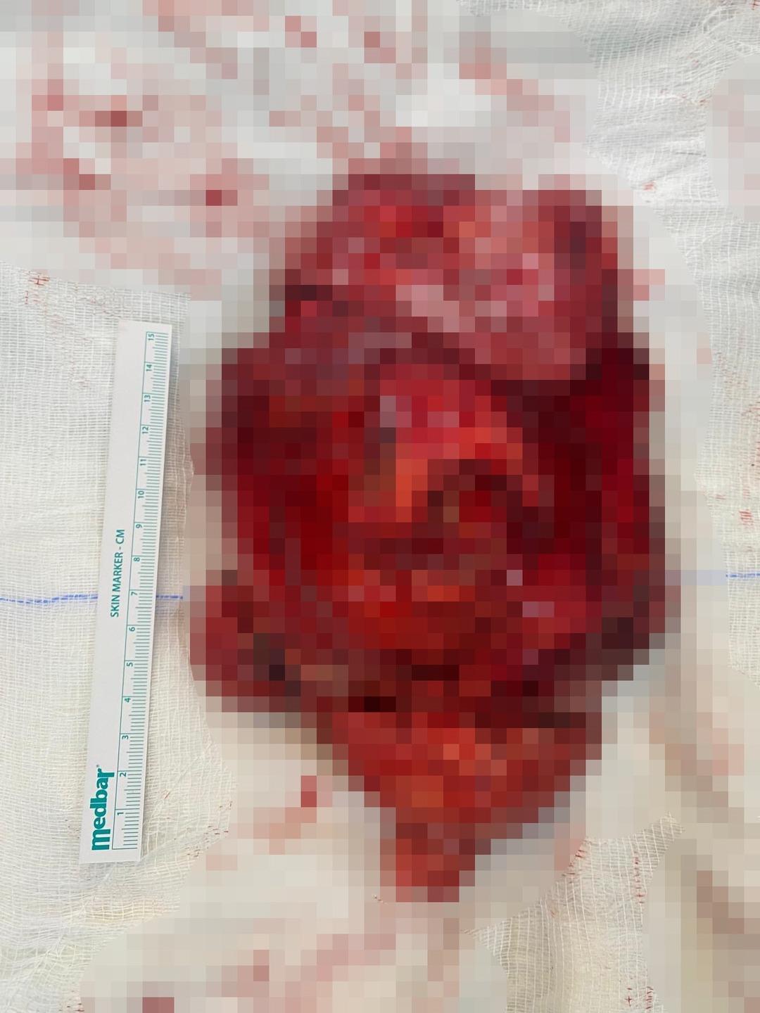 Her şey geçmeyen öksürükle başladı... Tıpta ender rastlanıyor: Dev tümör ameliyatla çıkarıldı! 2