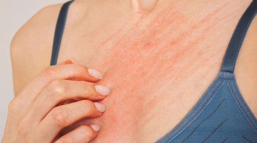 Dikkat! Bir ilde uyuz salgını! Vakalarda ciddi artış yaşanıyor