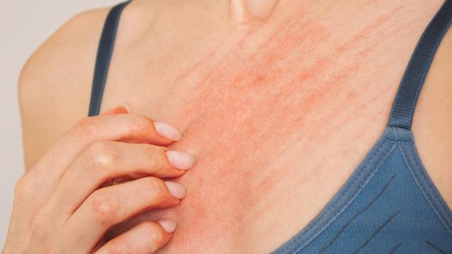 Dikkat! Bir ilde uyuz salgını! Vakalarda ciddi artış yaşanıyor