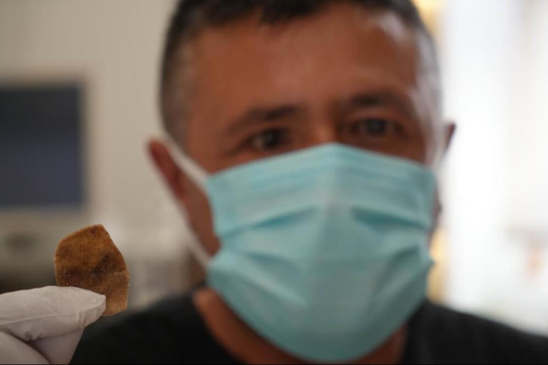 Protez gözündeki parça kaydı, hayatı kabusa döndü!  1