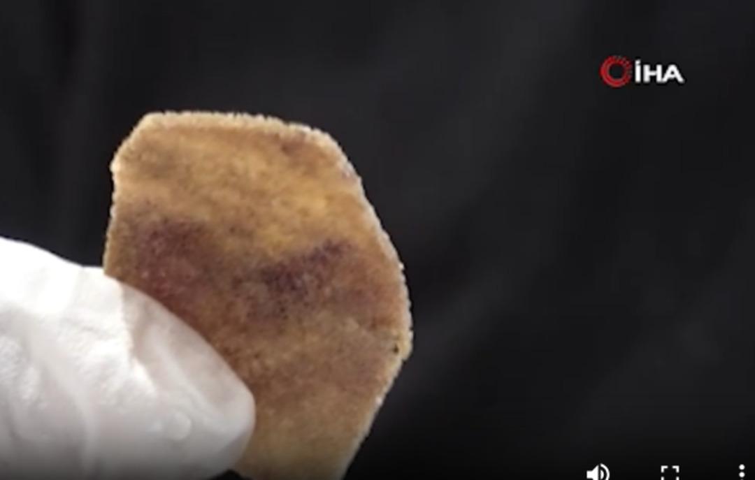 Protez gözündeki parça kaydı, hayatı kabusa döndü!  2