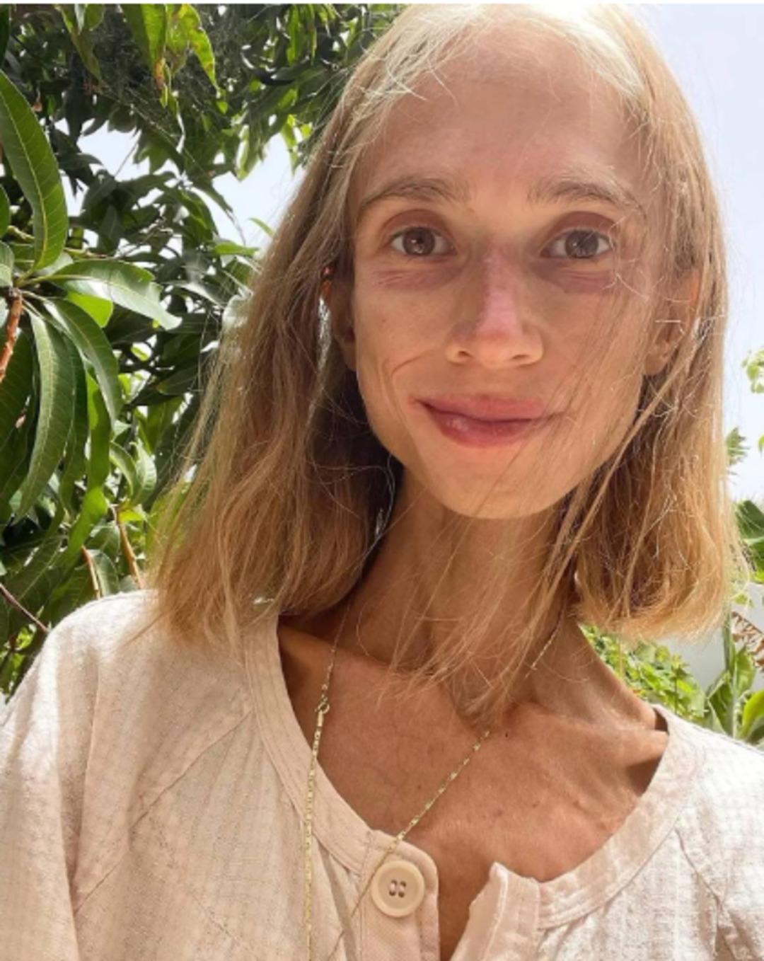 22 kiloya kadar düştü! Sosyal medya fenomeninin son hali yürek burktu: Sadece o diyeti yaparak... 4