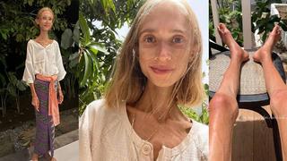 22 kiloya kadar düştü! Sosyal medya fenomeninin son hali yürek burktu: Sadece o diyeti yaparak...