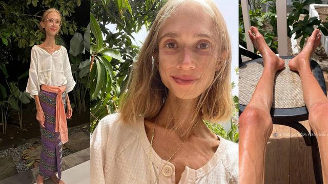 22 kiloya kadar düştü! Sosyal medya fenomeninin son hali yürek burktu: Sadece o diyeti yaparak...