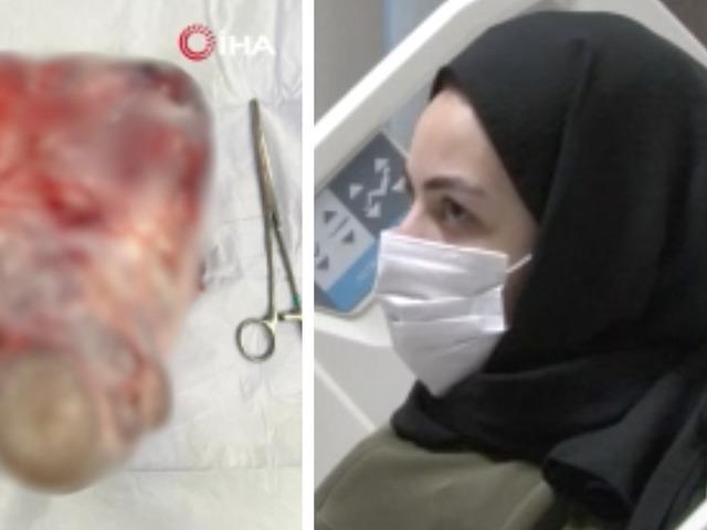 Karın şişliğinin diyetle geçeceğini sandı: 'Gazdır' dediler, 5 kiloluk dev kist çıktı! 