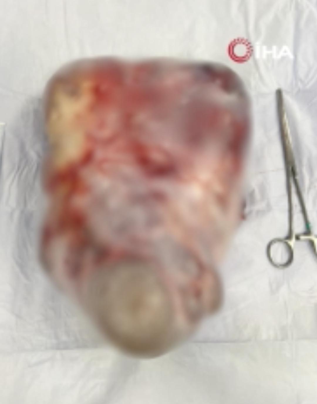 Karın şişliğinin diyetle geçeceğini sandı:  Gazdır  dediler, 5 kiloluk dev kist çıktı!  4