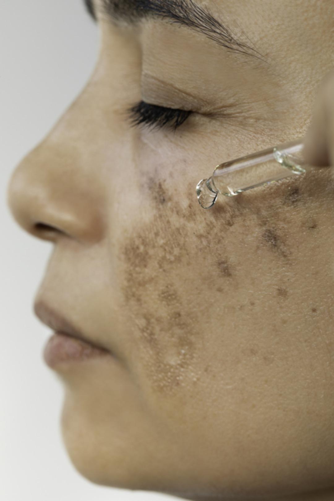 Lekeler, kuruluk, ince çizgiler… Cildiniz alarm veriyor olabilir: "Sonbahar cilt yenilenmesi için en uygun zaman" 3