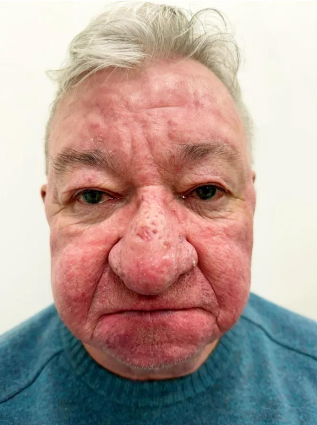 Gözlerinize inanamayacaksınız! Burnu her geçen gün büyüdü: Yemek bile yiyemez hale geldi... 1