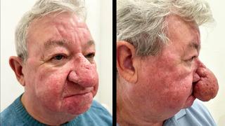 Gözlerinize inanamayacaksınız! Burnu her geçen gün büyüdü: Yemek bile yiyemez hale geldi...