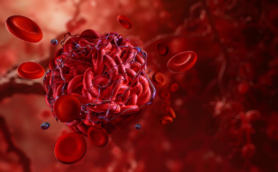 The most insidious and deadly disease of the modern age: 30,000 people die from thrombosis every year in Türkiye! 2