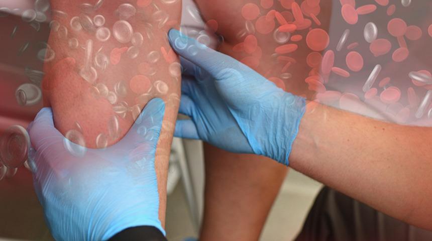 Modern çağın en sinsi ve ölümcül hastalığı: Türkiye'de her yıl 30 bin kişi tromboz nedeniyle hayatını kaybediyor! 