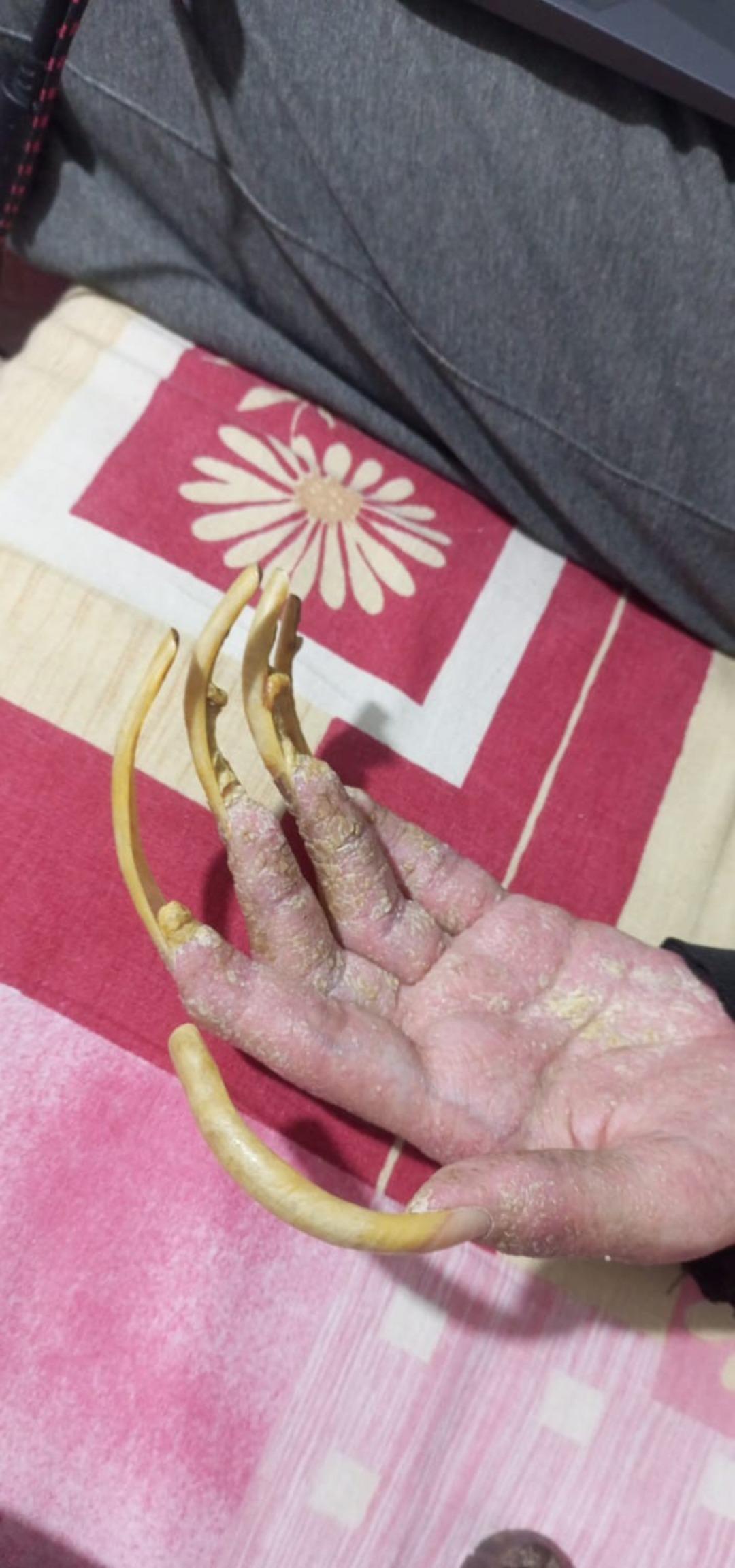 Okul birincisiydi telefona bağımlı hale geldi! 3 yıldır evden çıkmıyor: Duş almıyor, tırnaklarını kesmiyor 4