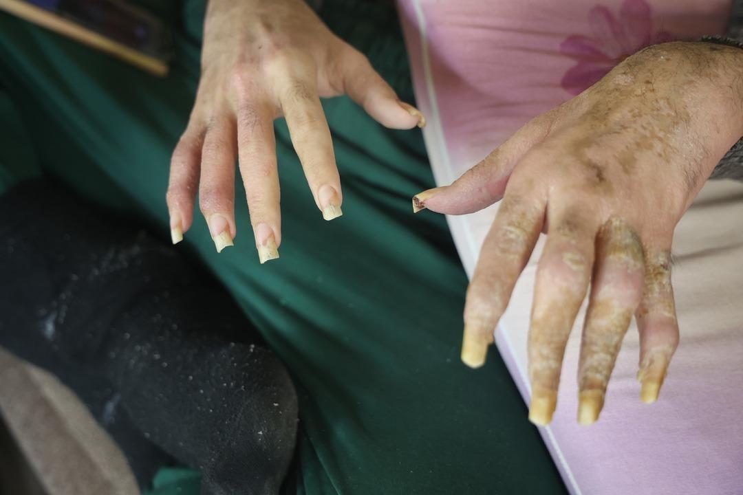 3 yıldır tırnaklarını kesmiyor, duş almıyordu! Eve kapanan gencin eski hali ortaya çıktı 3