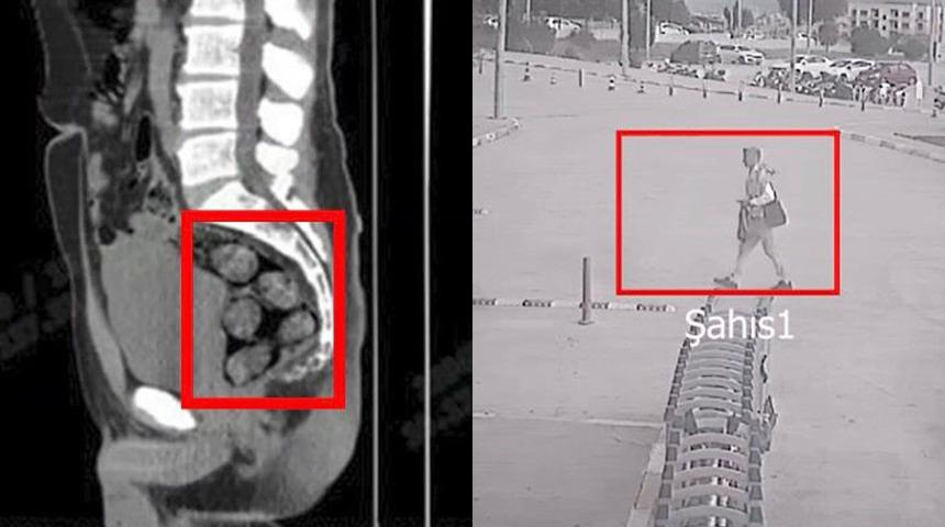 Tomografide şaşkına çeviren görüntü: Midesinde saklayıp Türkiye'ye gelmiş!