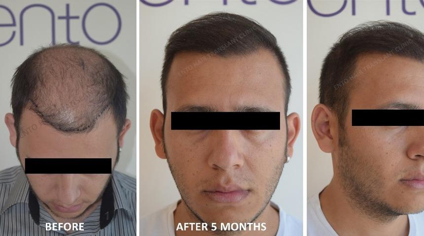 Sa&ccedil; ekiminden sonra bunları asla yapmayın