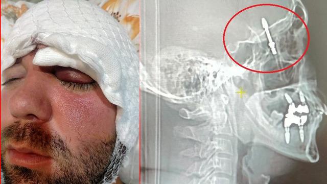 Bursa'da inanılmaz olay: Dişçiye gitti, hayatı kabusa döndü! Neredeyse ölüyordu