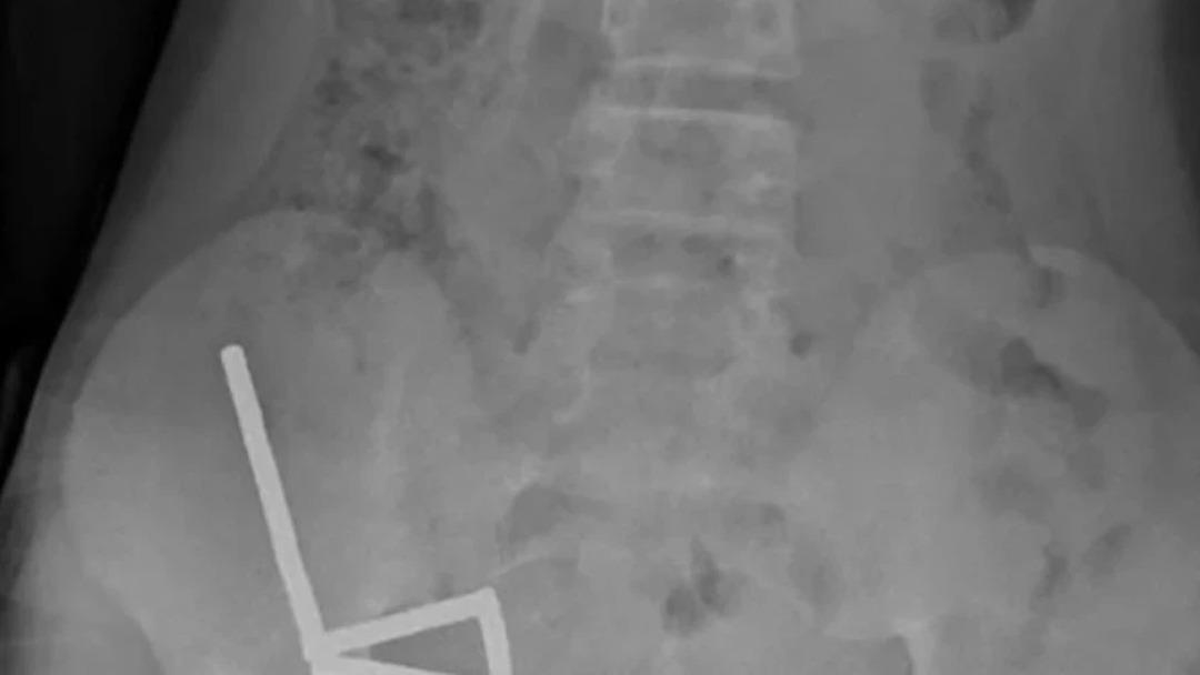 4 gün şiddetli karnı ağrıdı: Gerçek röntgende ortaya çıktı! 100 güçlü mıknatısı görenler hayrete düştü! Tıp tarihine geçti... 2