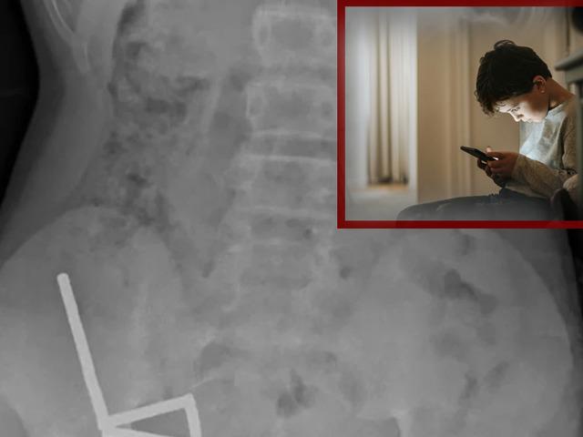 4 gün şiddetli karnı ağrıdı: Gerçek röntgende ortaya çıktı! 100 güçlü mıknatısı görenler hayrete düştü! Tıp tarihine geçti...