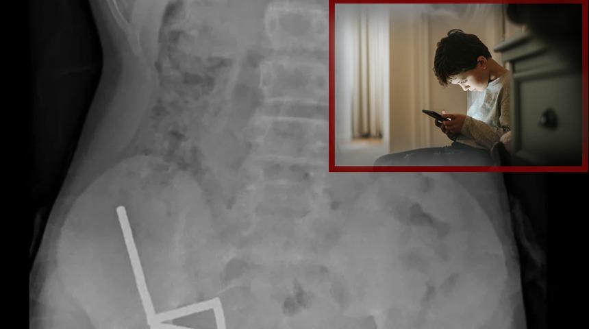 4 gün şiddetli karnı ağrıdı: Gerçek röntgende ortaya çıktı! 100 güçlü mıknatısı görenler hayrete düştü! Tıp tarihine geçti...