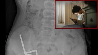 4 gün şiddetli karnı ağrıdı: Gerçek röntgende ortaya çıktı! 100 güçlü mıknatısı görenler hayrete düştü! Tıp tarihine geçti...