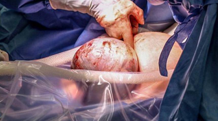 Doğum esnasında 80 binde 1 g&ouml;r&uuml;len mucize ger&ccedil;ekleşti